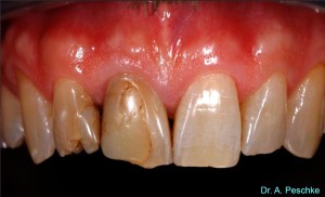 Patient presents himself with old, discolored large restorations and fractures.