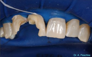 The operative field is insulated from the oral cavity to prevent contamination of the adhesive interfaces. The old restorations are removed and bevels placed.